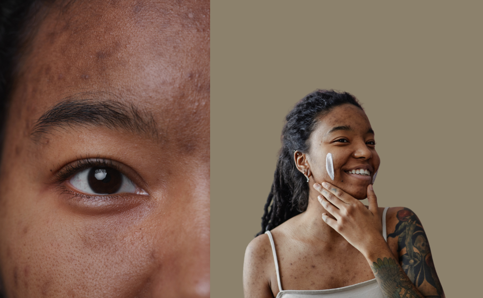 Two photos of a Black women, in one, it's a close-up of her face, and in the other, she's doing skincare to show How to Manage Hormonal Acne During Your Period